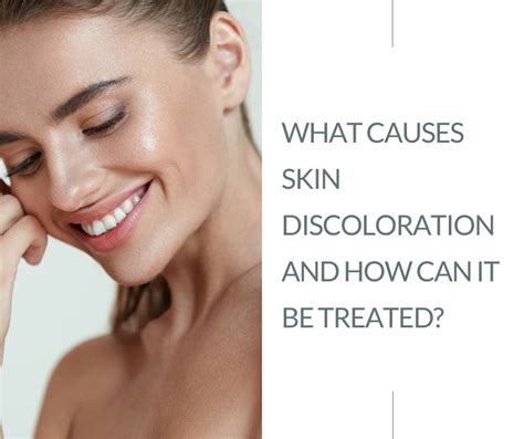 Skin discoloration is treated with milady - Study with Quizlet and memorize flashcards containing terms like What should sensitive skin be treated with?, When performing a skin analysis, the first step is always _____., Sun damage is a condition defined by _____. and more. 